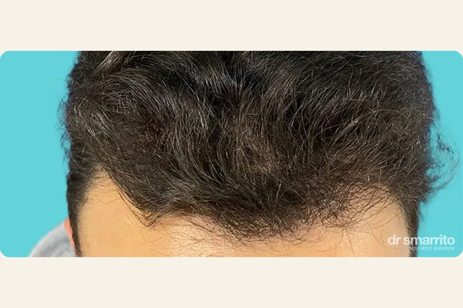 Après greffe de cheveux FUE de la ligne frontale – chirurgie esthétique Dr Smarrito