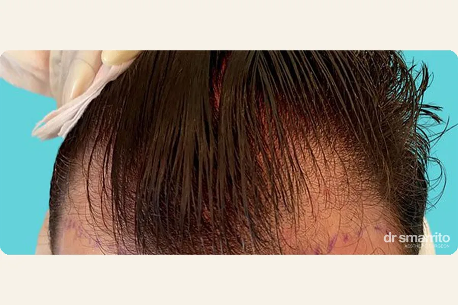 Avant greffe de cheveux de la ligne frontale, marquage – chirurgie esthétique Dr Smarrito