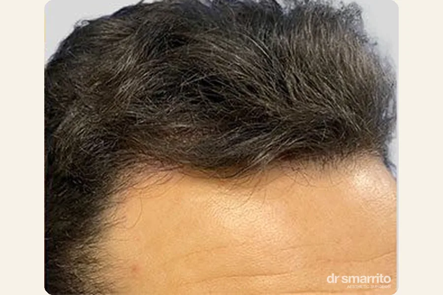 Après greffe de cheveux des golfes FUE – chirurgie esthétique Dr Smarrito