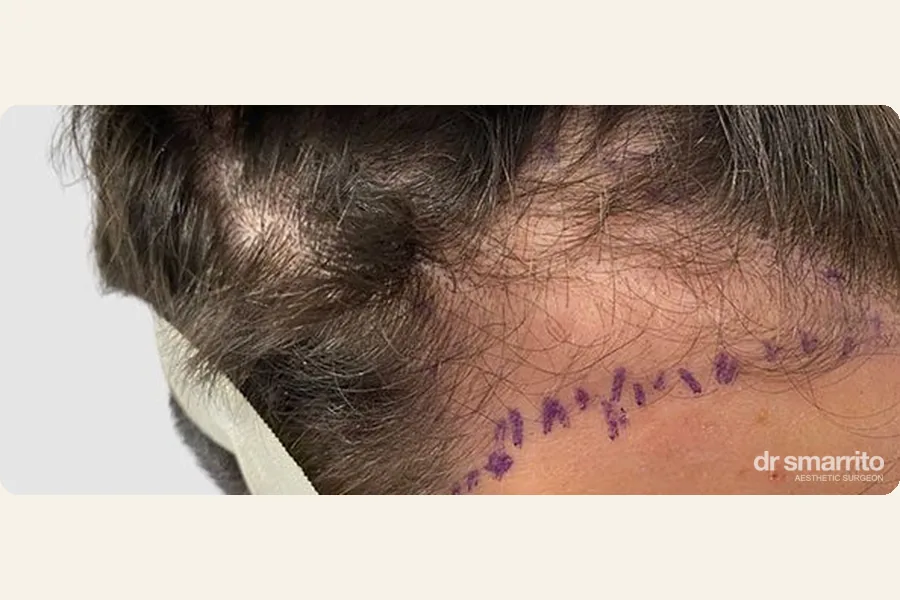 Avant greffe de cheveux des golfes, marquage – chirurgie esthétique Dr Smarrito