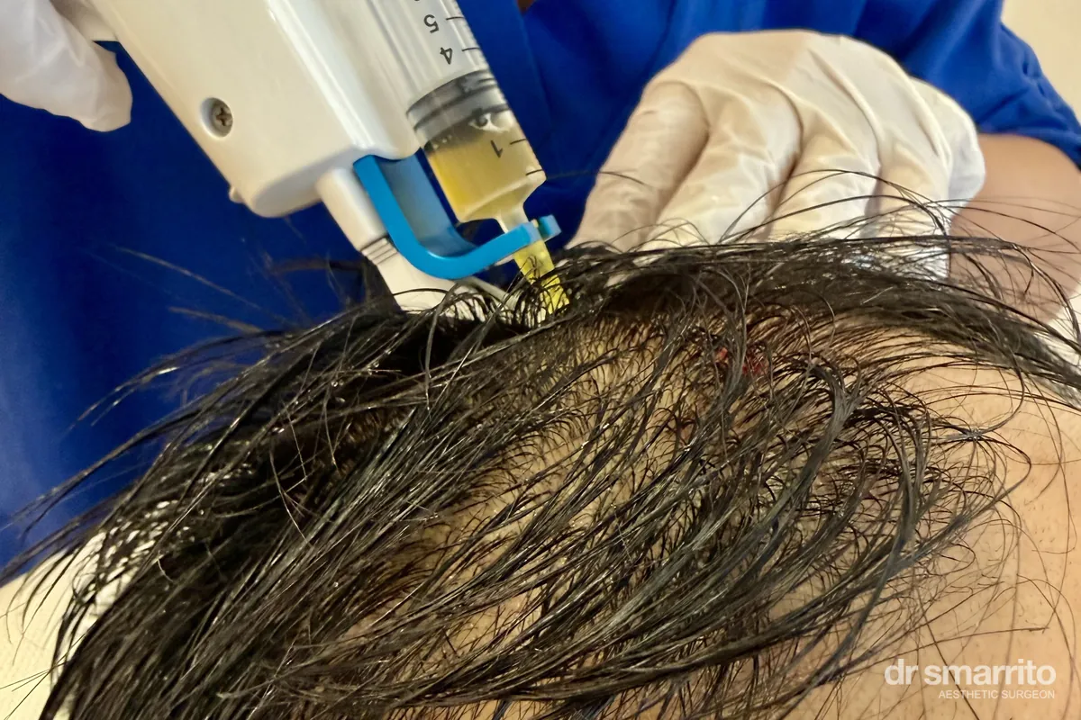 Injection de PRP dans le cuir chevelu au pistolet injecteur – médecine esthétique Dr Smarrito