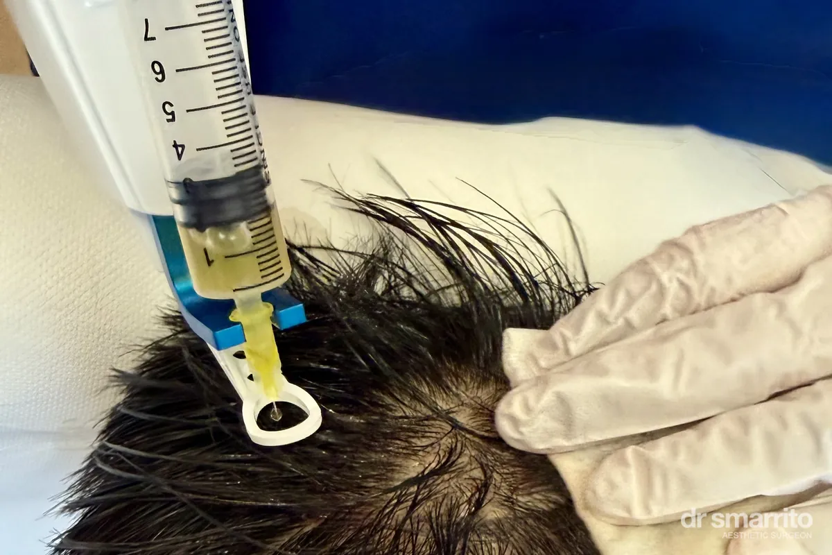 Micro-injections de PRP au vertex – médecine esthétique Dr Smarrito
